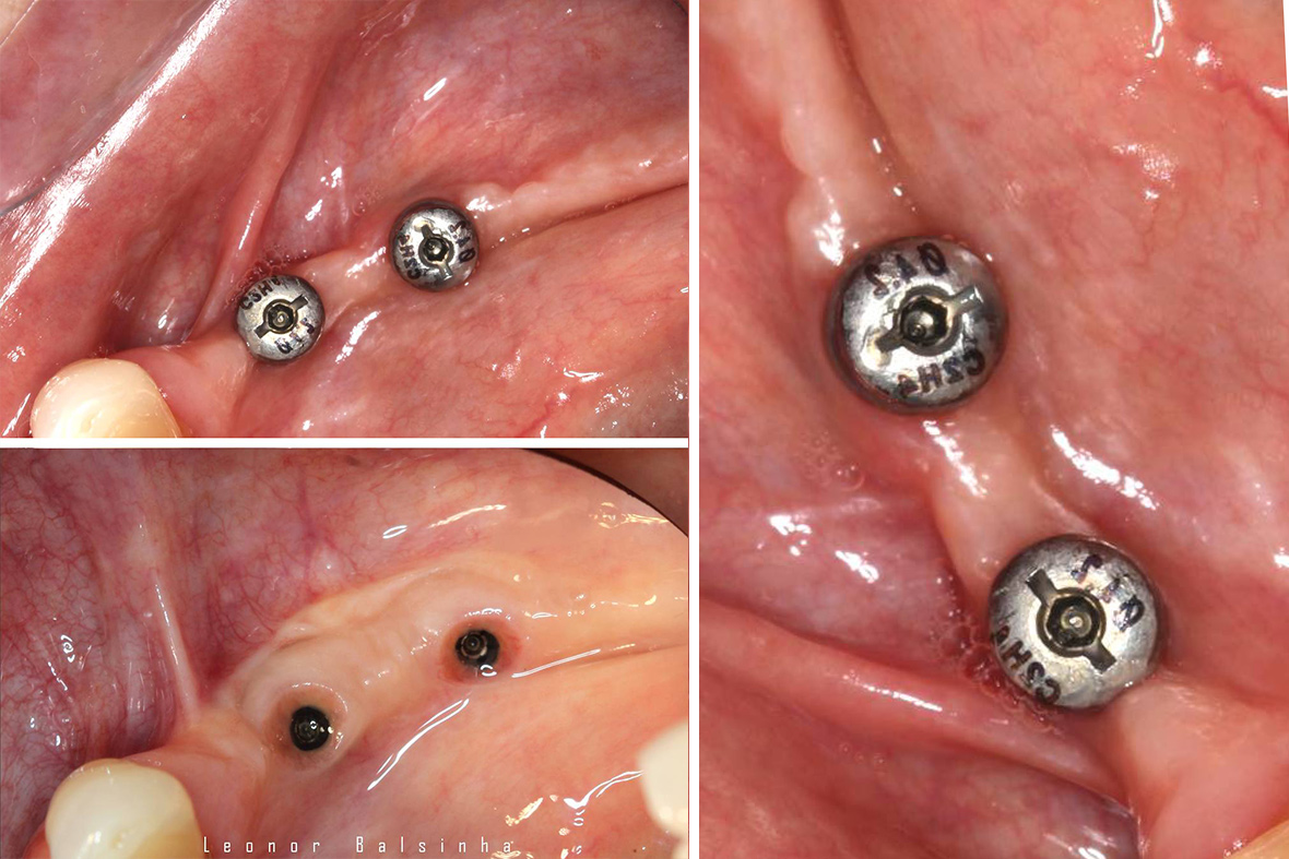 Implantologia Oral
