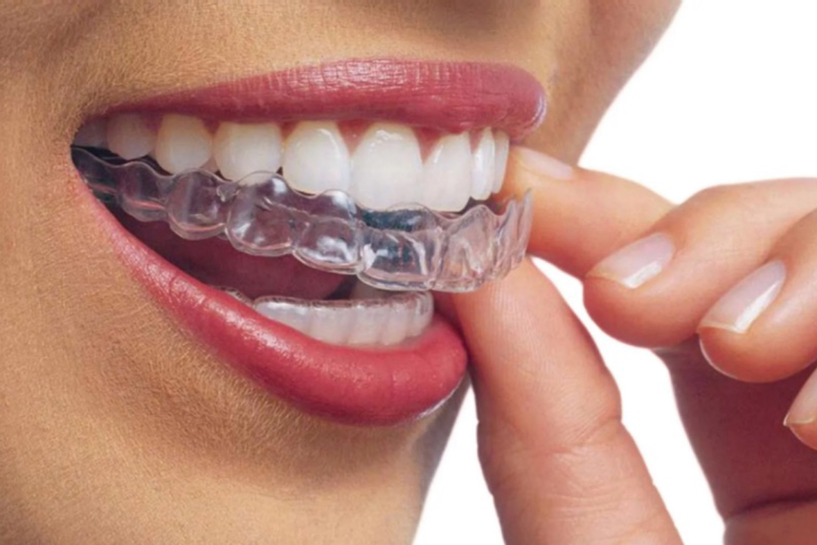 Invisalign